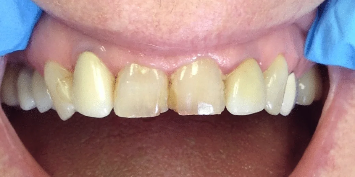 Before photo for crown case 6 smile transformation