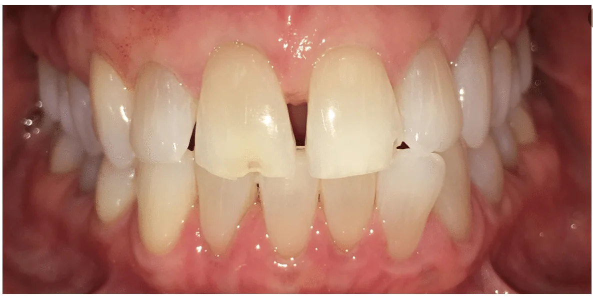 Before photo for crown case 1 smile transformation