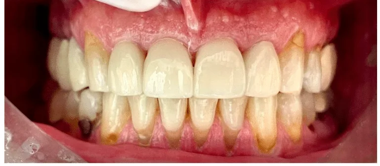 After photo for crown case 2 smile transformation