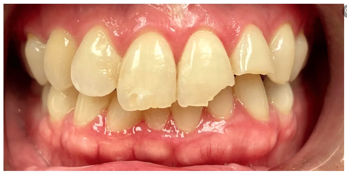 Before photo for crown case 3 smile transformation